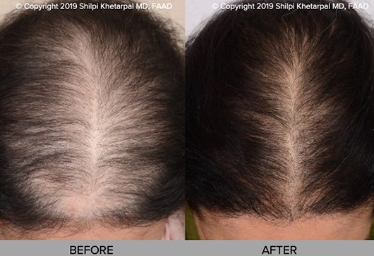 Platelet-Rich Plasma (PRP) Hair Restoration